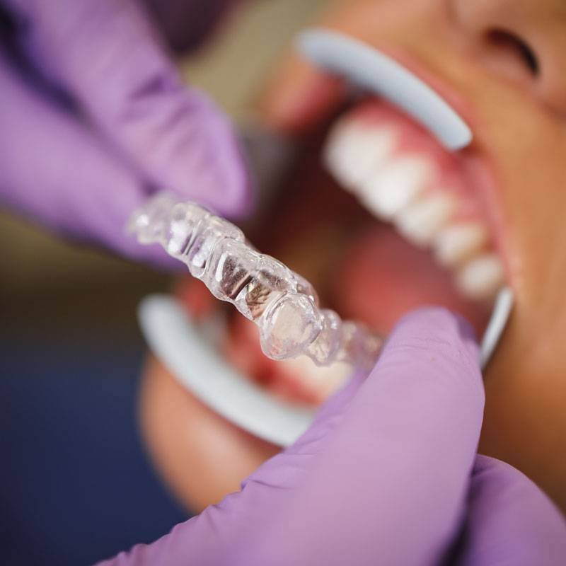 Clear Invisalign aligner being fitted